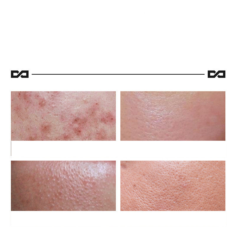 Herbal Lightening Acne Cream
